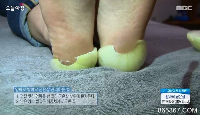 硬脚皮怎么去掉 韩国节目推荐用洋葱去脚皮超可爱
